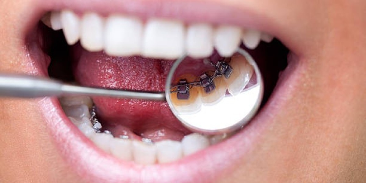 Get the Perfect Smile: Braces in Riyadh Made Easy