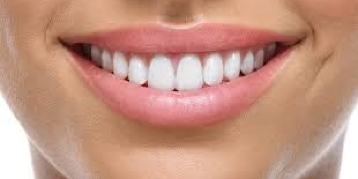 E-Max Veneers in Riyadh: Customized Solutions for Every Smile