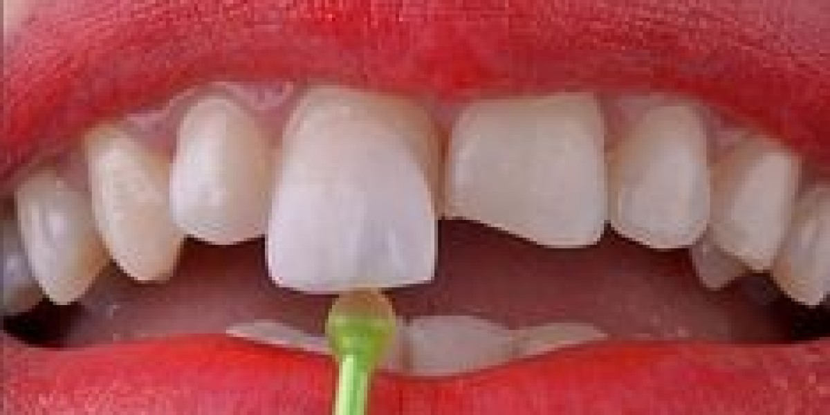 ايماكس فينيرز: الحل الأمثل لابتسامة خالية من العيوب