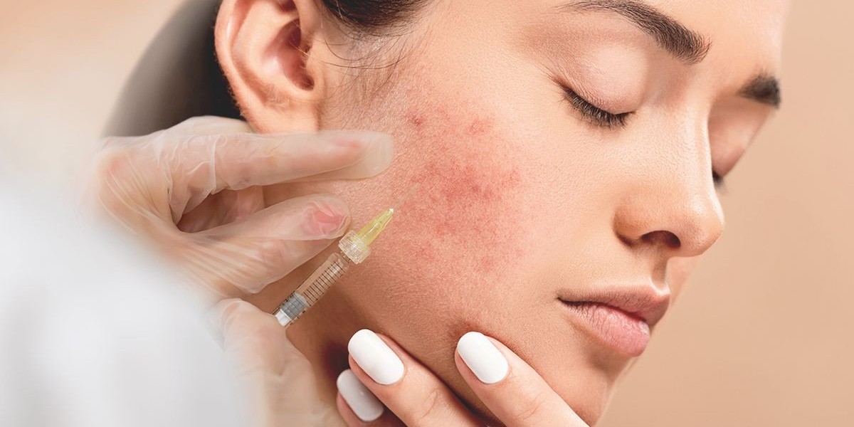 Advanced Laser Treatment for Pimples in Riyadh