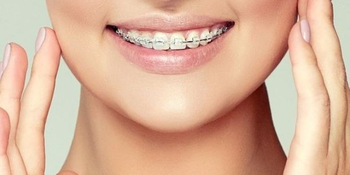 The Benefits of Choosing Metal Braces in Riyadh for Teeth Alignment