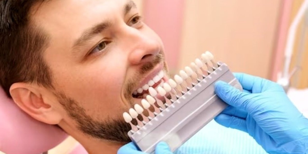 Stability together with A long life for Teeth Laminate An in-depth Examination
