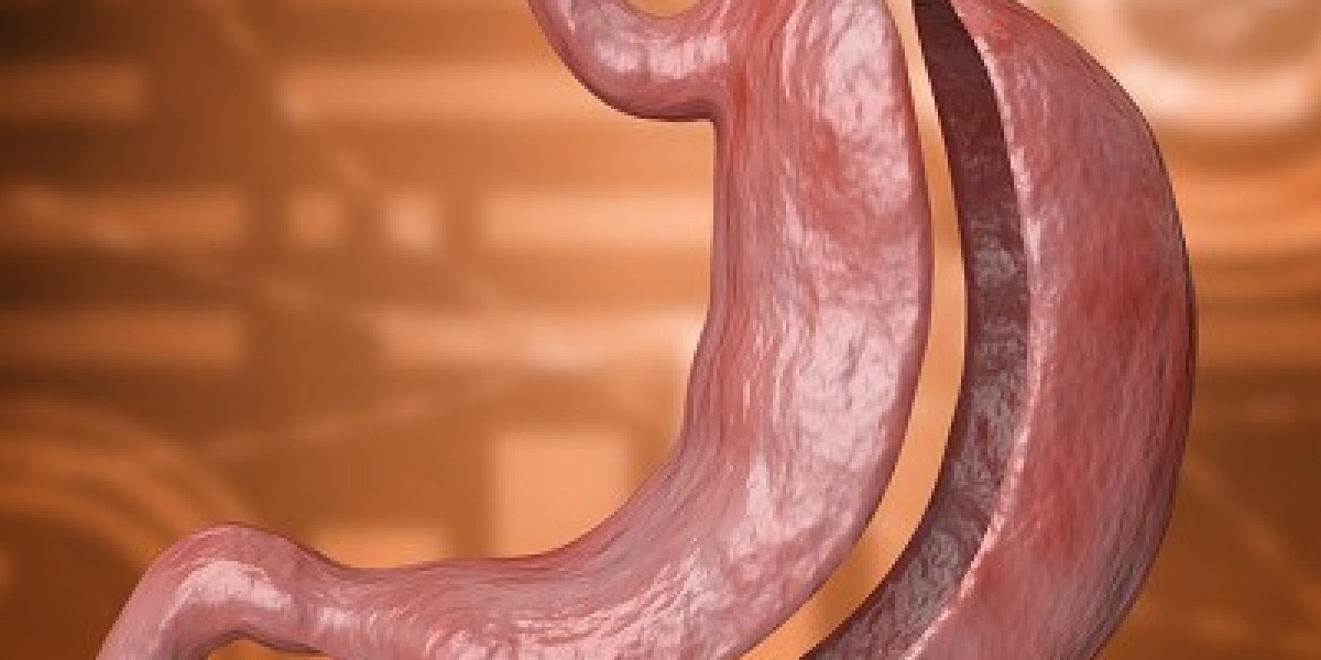 Can Bariatric Surgery Be Done Laparoscopically?