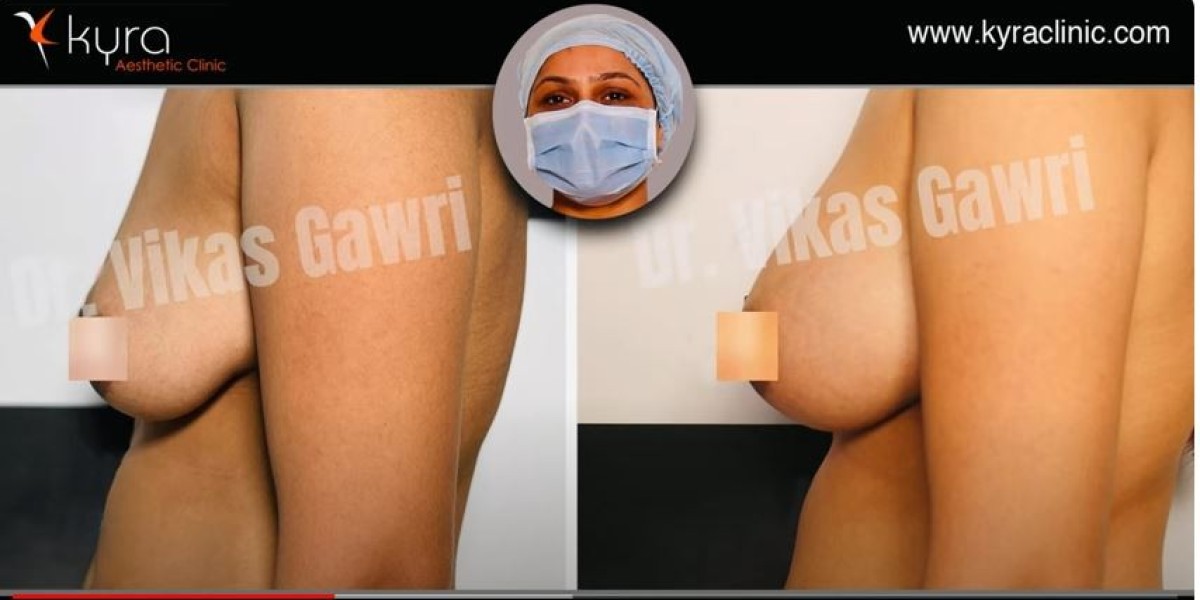 Breast Lift Cost in Punjab at Kyra Clinic