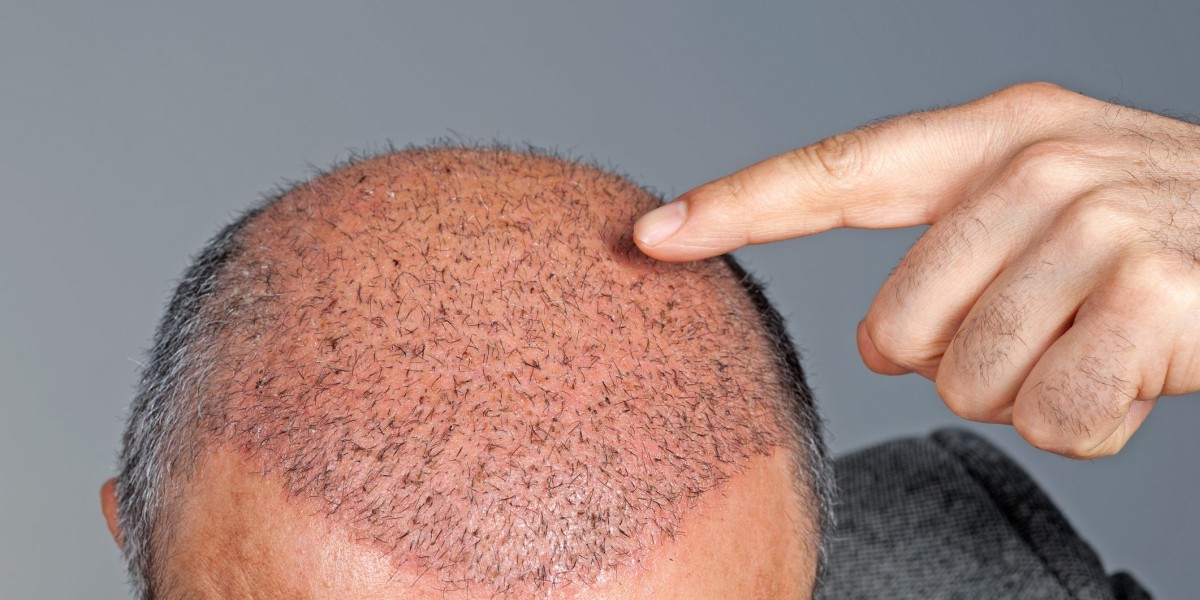 Everything You Need to Know About Stem Cell Hair Transplants in Riyadh