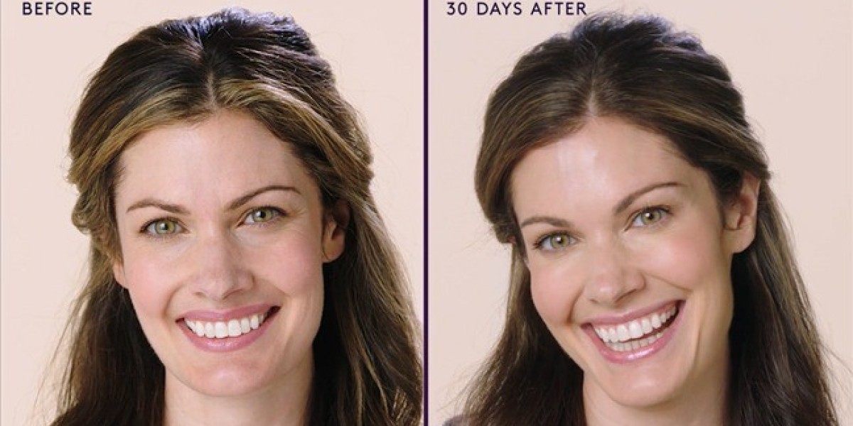 How Botox Targets Wrinkles Around the Eyes for a Youthful Look