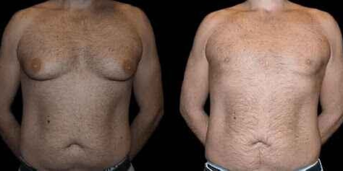 Success Rate of the Best Gynecomastia Surgeon in Dubai: What to Know