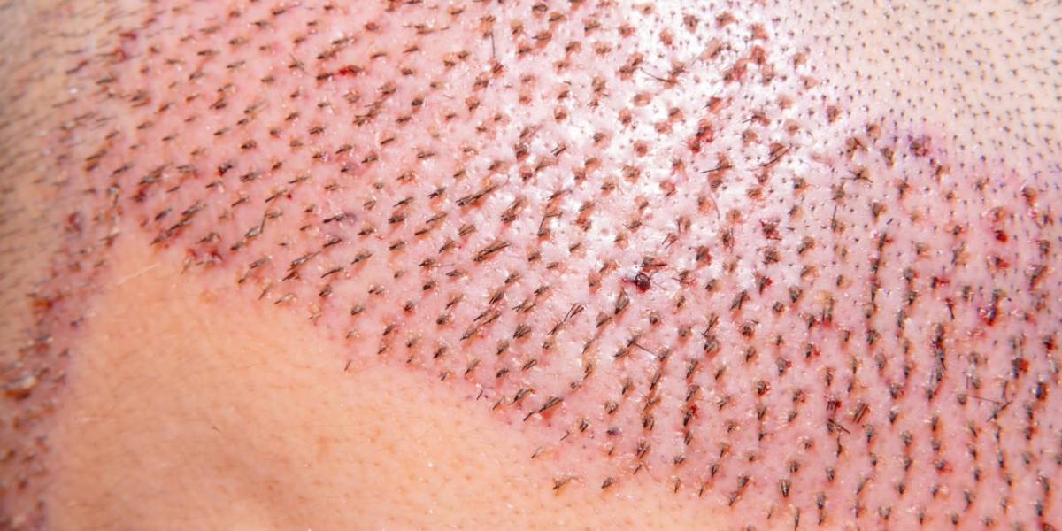 Dubai Hair Transplant: Discover the Cost and Benefits