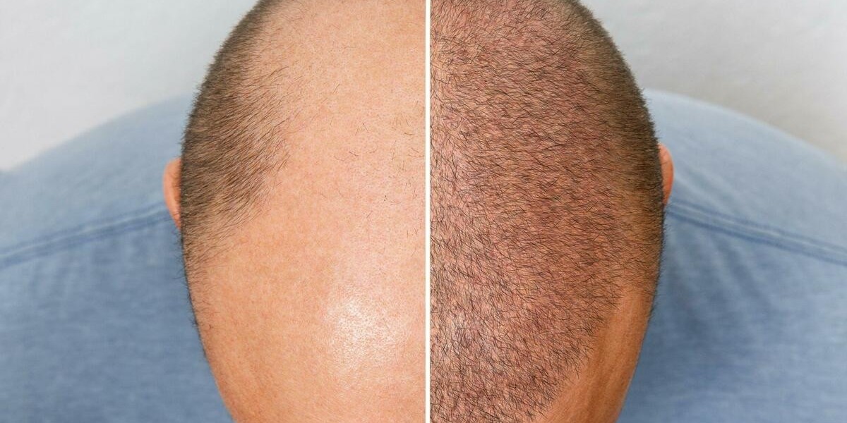 GFC Treatment for Hair Thinning in Riyadh