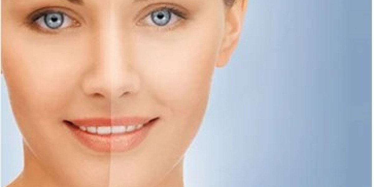 Understanding the Cost of Permanent Skin Whitening Injections