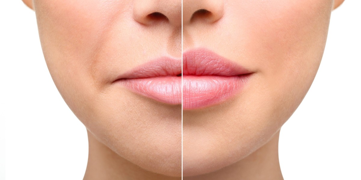Lip Augmentation in Riyadh: Questions to Ask Before You Book