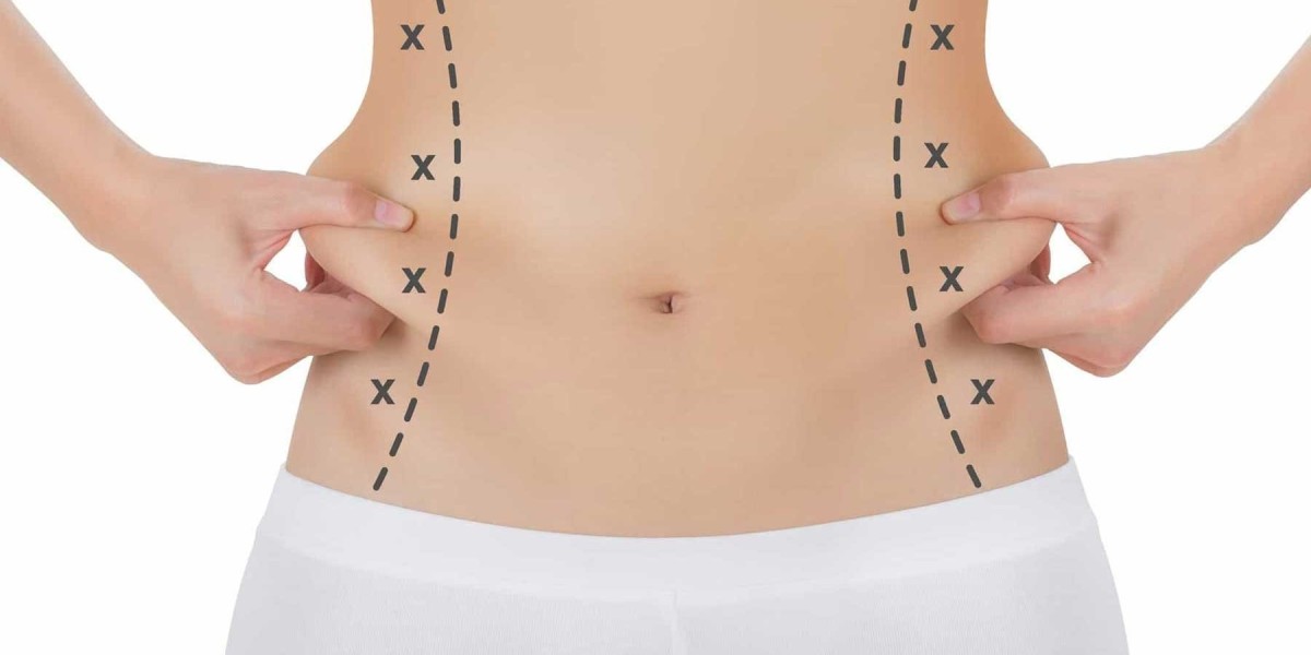 Exploring the Diverse Liposuction Surgery Options in Dubai