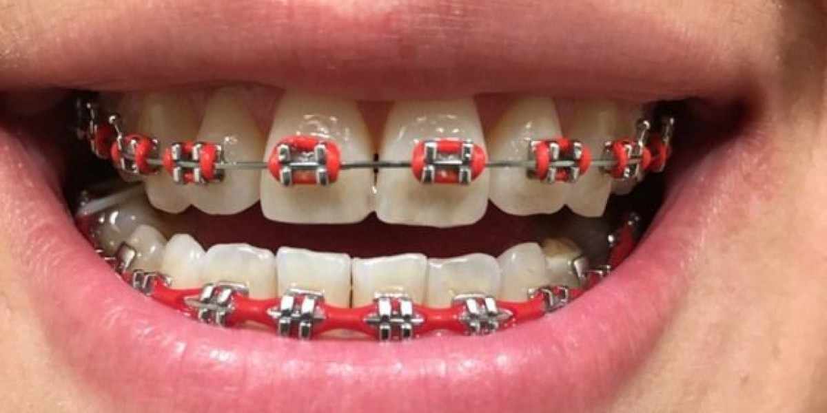 Teeth Braces and Oral Hygiene: Keeping Your Smile Healthy