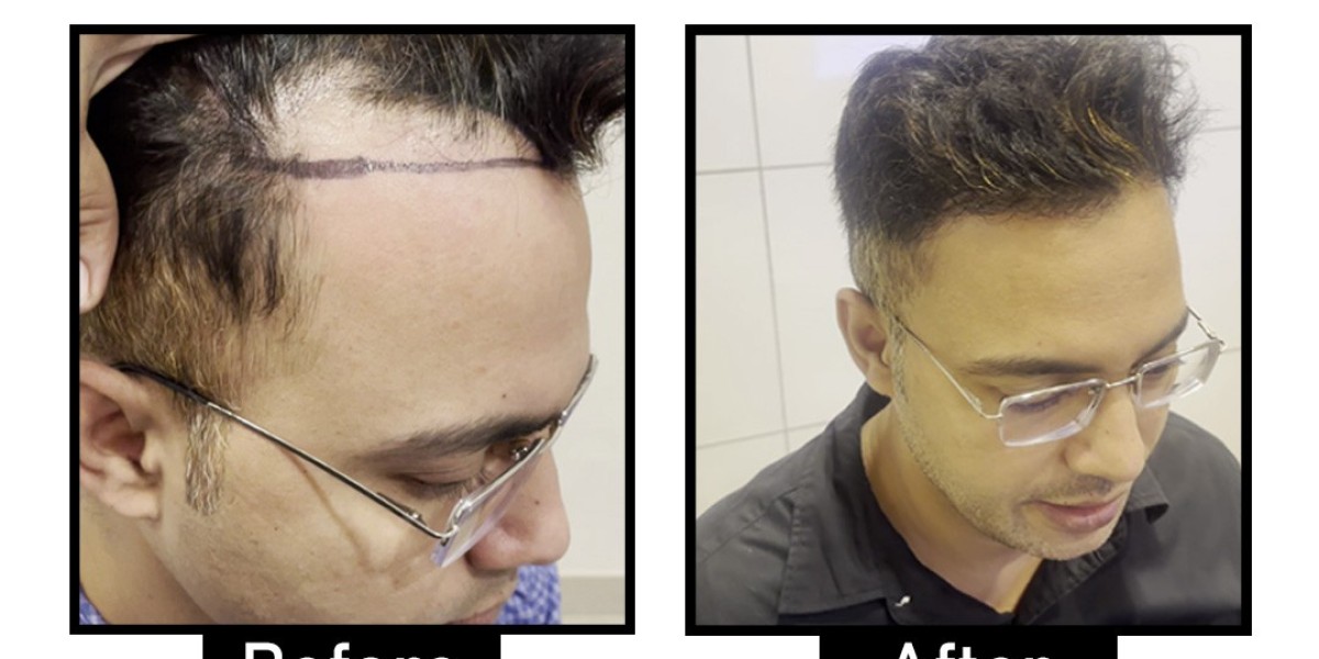Best Hair Loss Treatment in Delhi: Restore Your Hair and Confidence