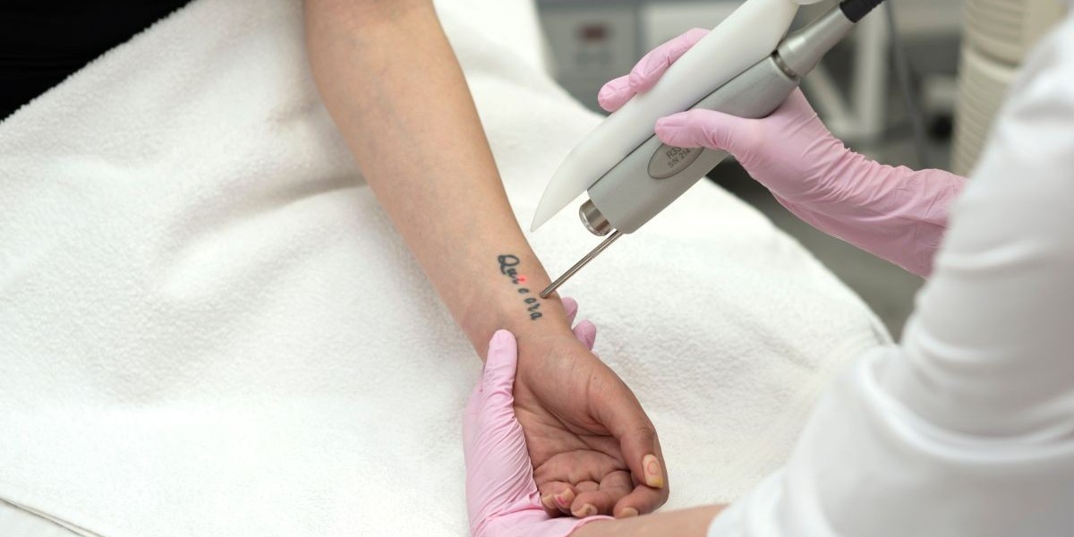 The Future of Laser Tattoo Removal in Dubai: Exploring Technological Benefits