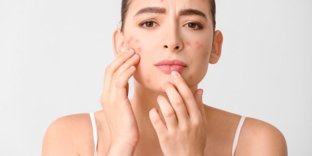 Targeting Acne: Innovative Treatments for All Skin Types
