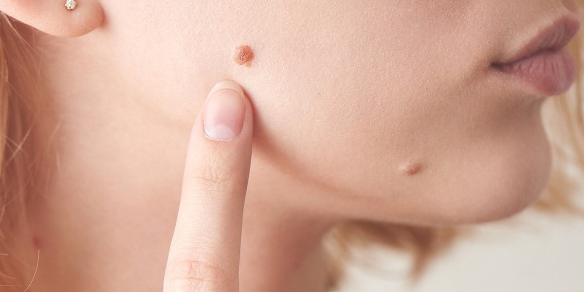Minimally Invasive Mole Removal Options in Riyadh