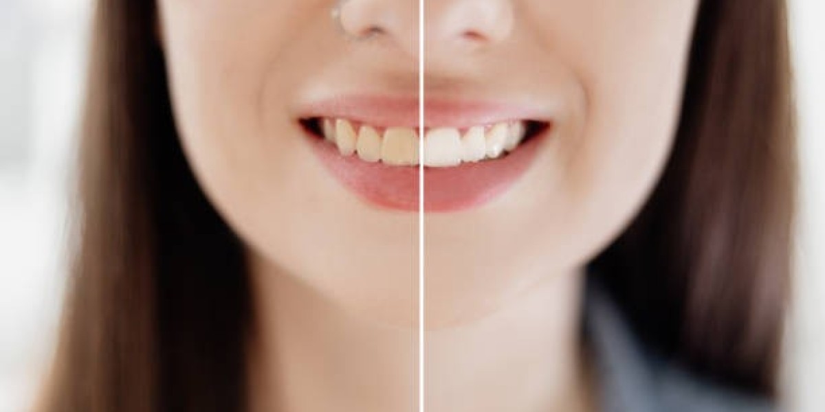 The Dos and Don’ts of Home Teeth Whitening in Riyadh