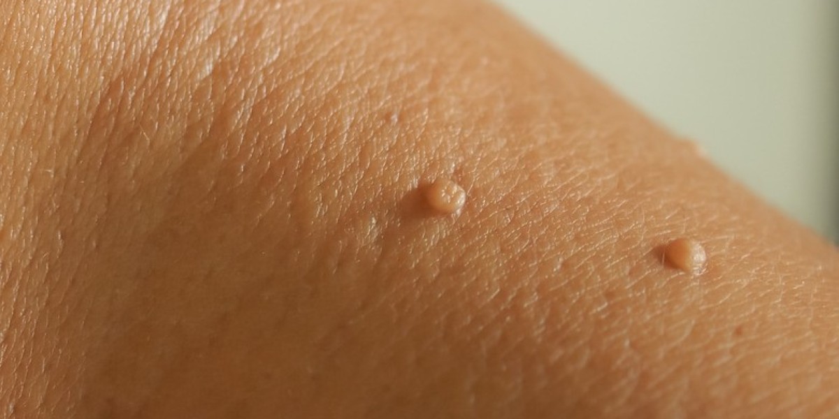 Innovative Techniques for Skin Tag Removal: What’s Trending in Dubai?