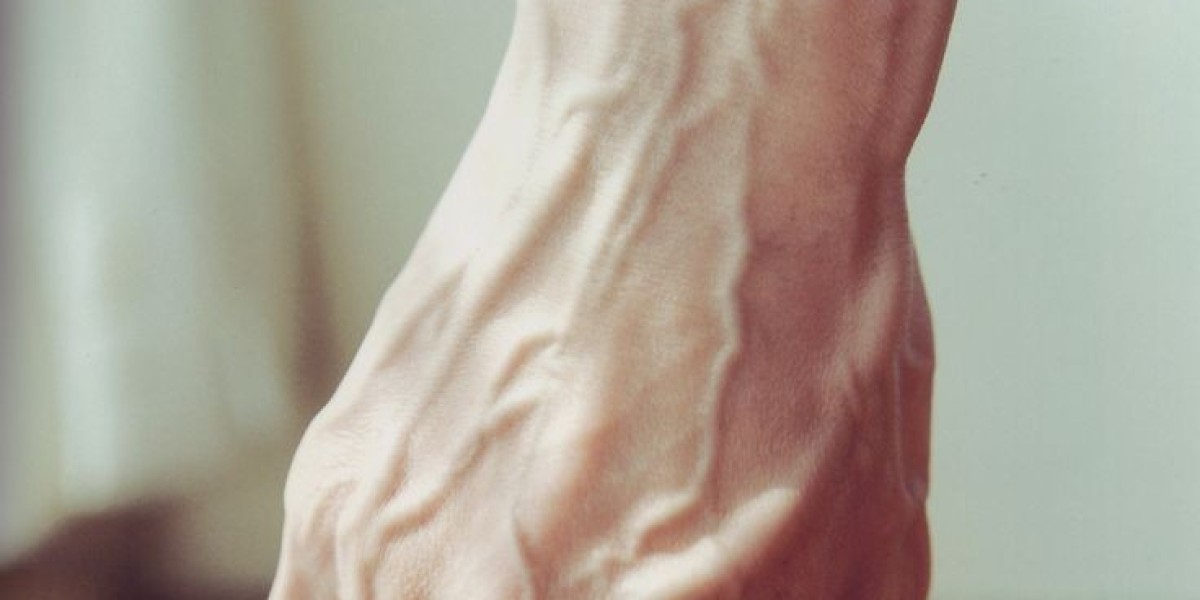 How to Choose the Right Clinic for Spider Veins in Riyadh