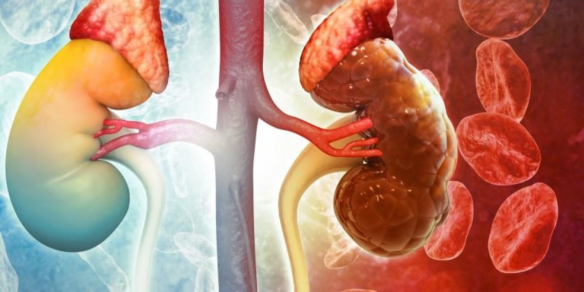 Acute Kidney Injury Treatment: Diagnosing Acute Kidney Injury