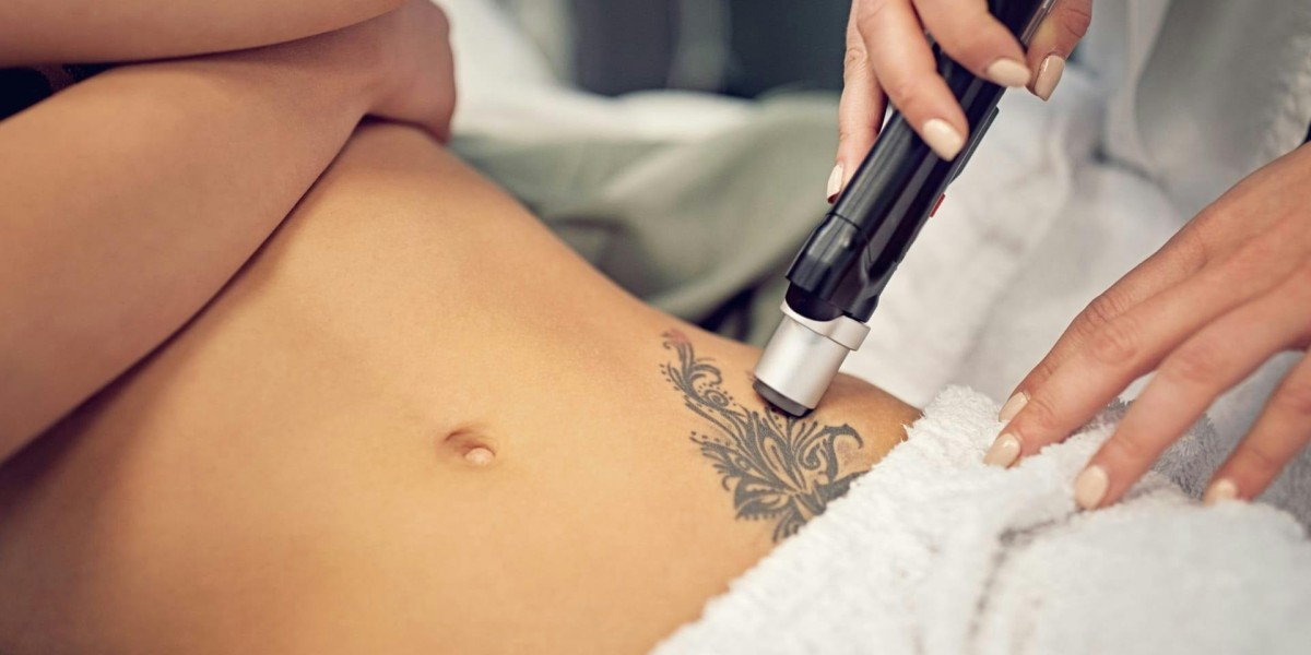 The Role of Technology in Laser Tattoo Removal Treatments