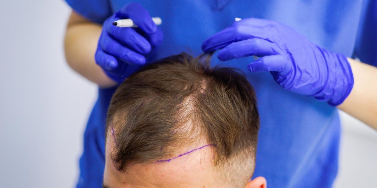 Is It Cheaper to Get a Hair Transplant in Riyadh?