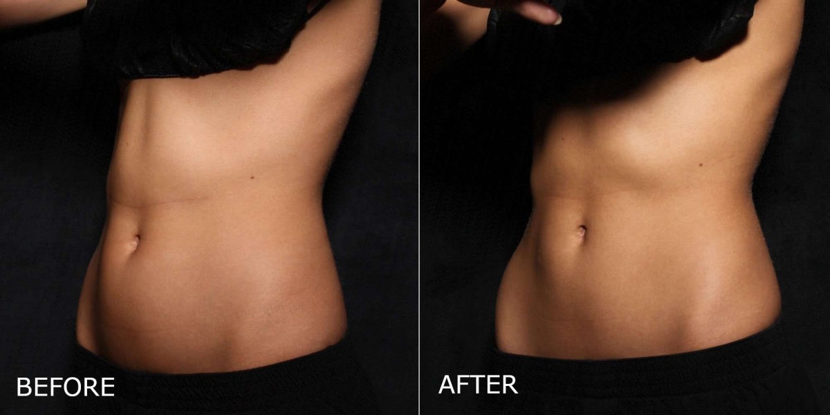 Dubai's Top Choice: CoolSculpting for Fat Loss