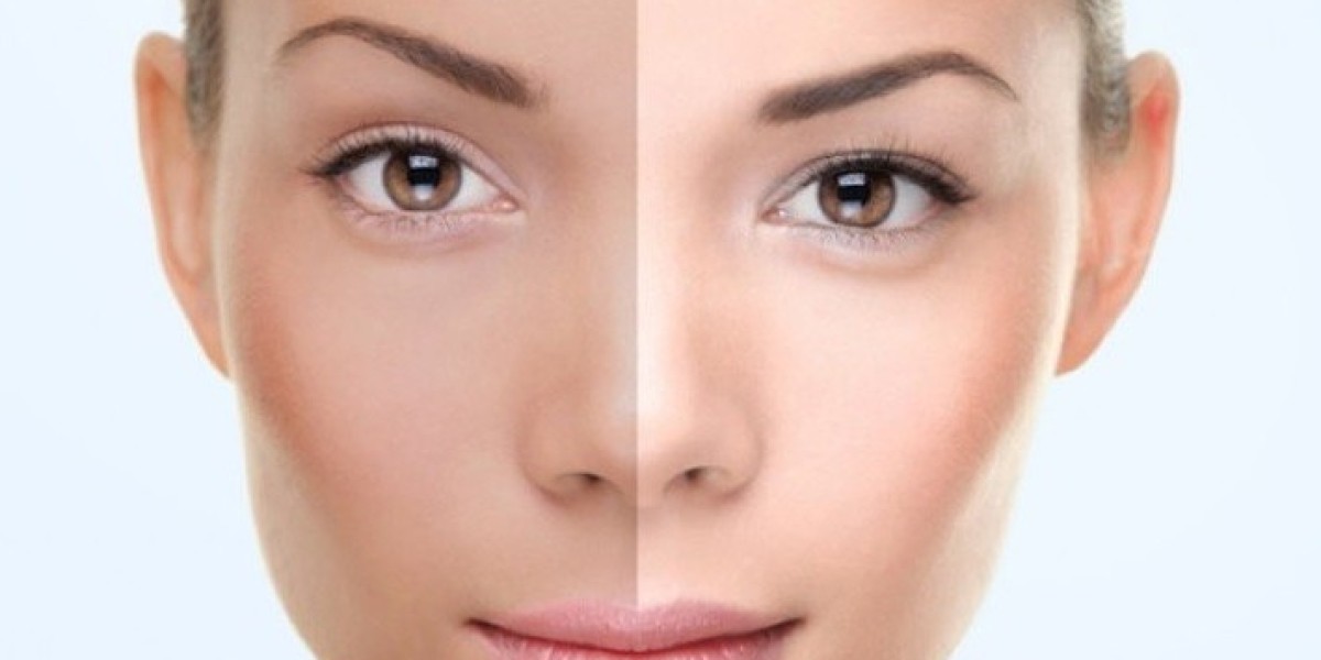 Understanding the Benefits of Permanent Skin Whitening Treatments in Dubai