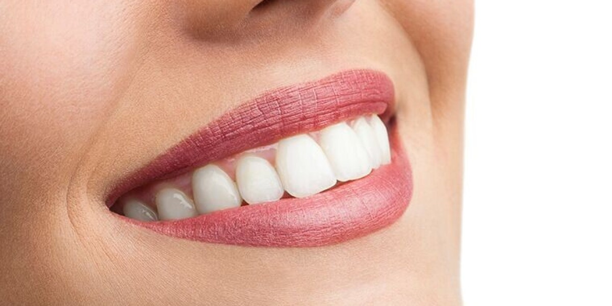 Expert Tips for Maintaining Your Teeth Whitening Results