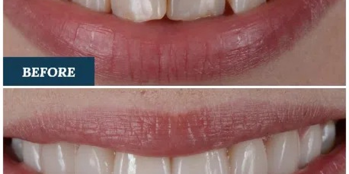 The Essentials of Dental Veneers: Insights for Dubai Patients