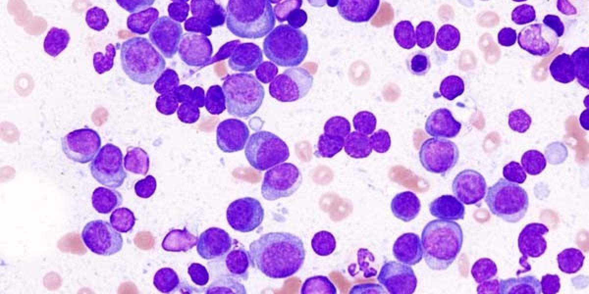 Global Multiple Myeloma Market Size, Statics, Future, Forecasts To 2032