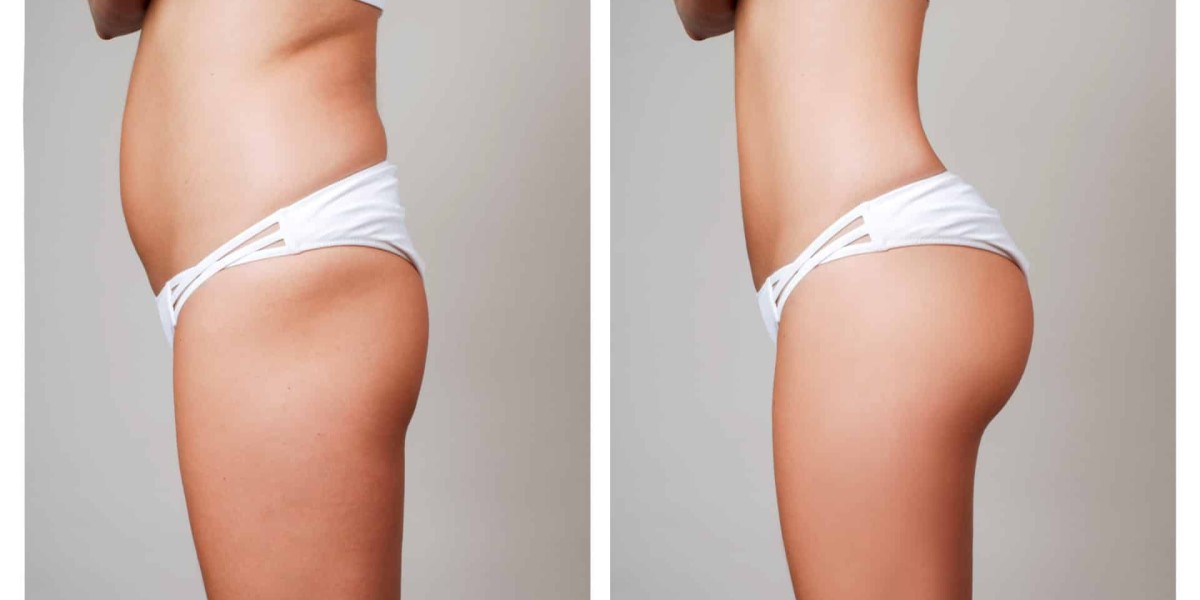 Achieve Natural-Looking Curves with BBL in Riyadh