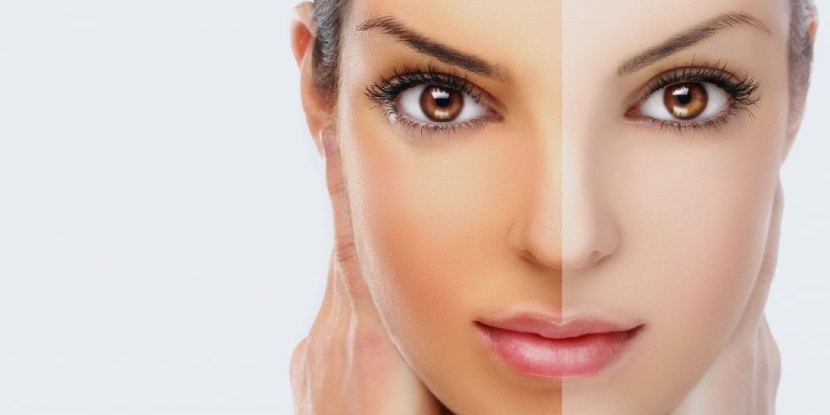 Chemical Peels: A Popular Choice for Skin Whitening in Riyadh