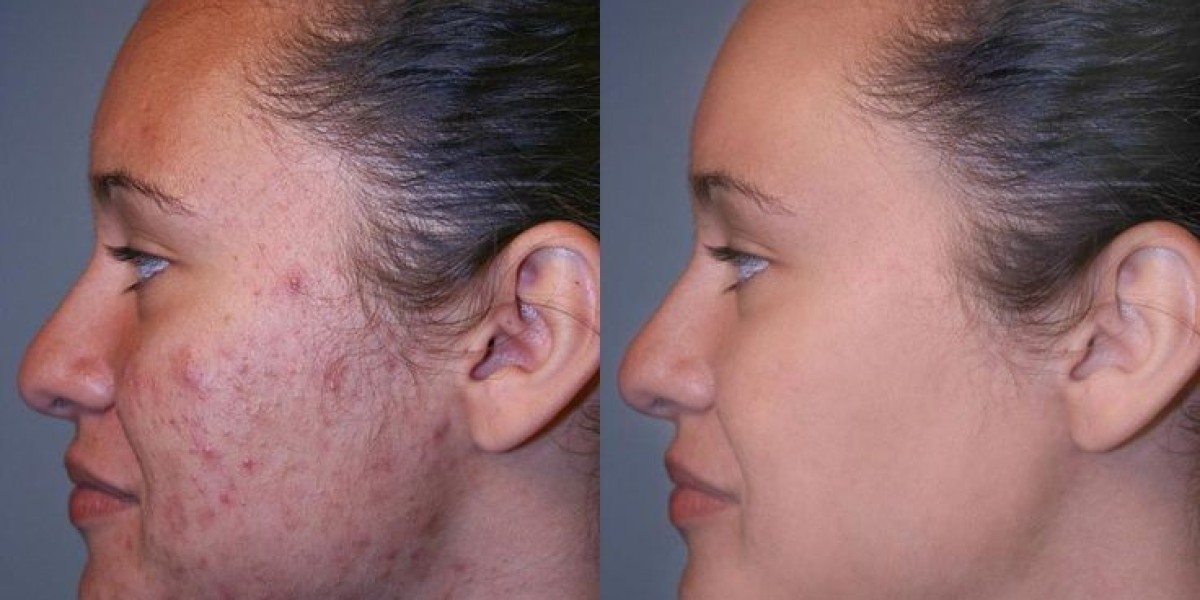 Laser Scar Removal: Find the Best Specialists in Riyadh