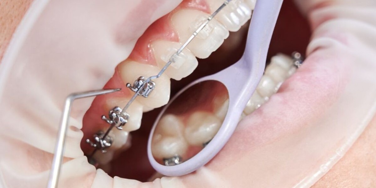 Amazing Smile Transformations: Braces in Dubai Before and After