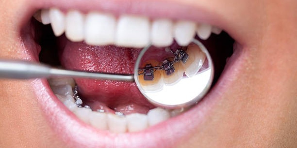 Straighten Your Smile with Braces in Riyadh