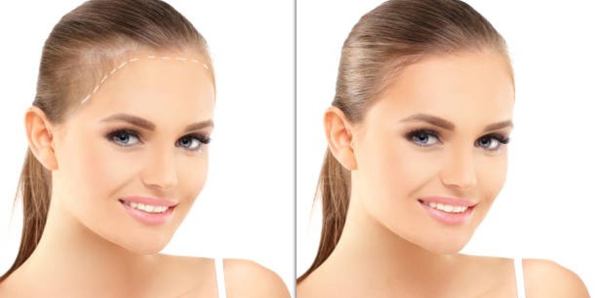 كل ما تحتاج معرفته عن زراعة الشعر في الرياض