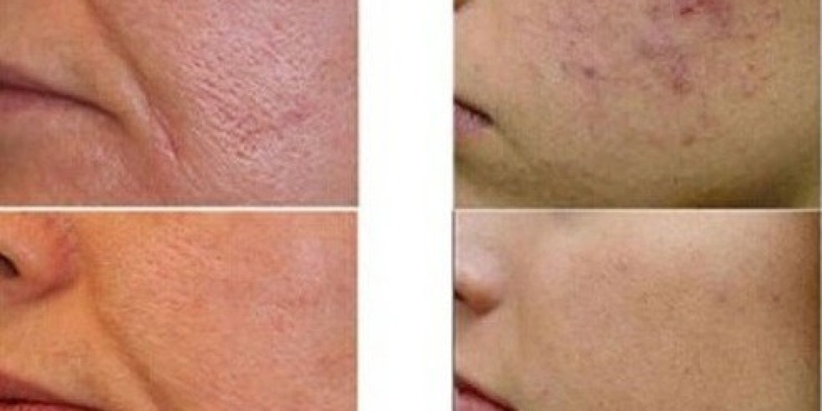 Laser Scar Removal Reviews: Patient Experiences in Riyadh