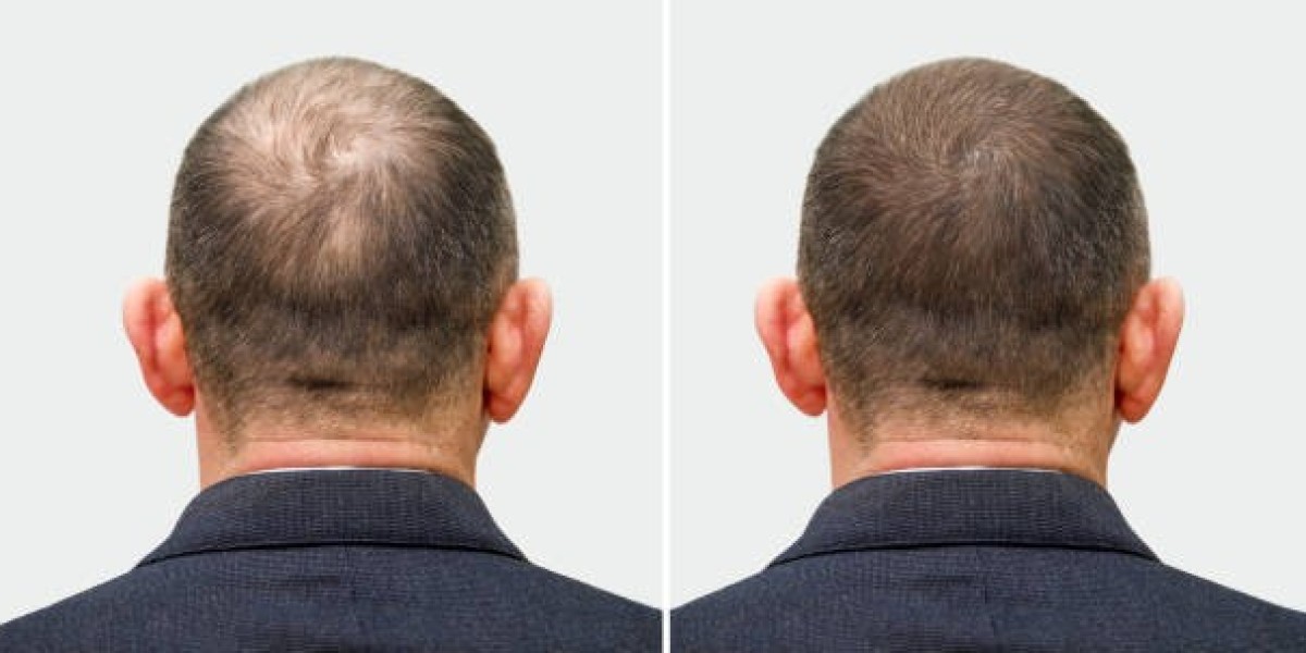 The Economic Impact of Hair Transplants in Ras Al Khaimah