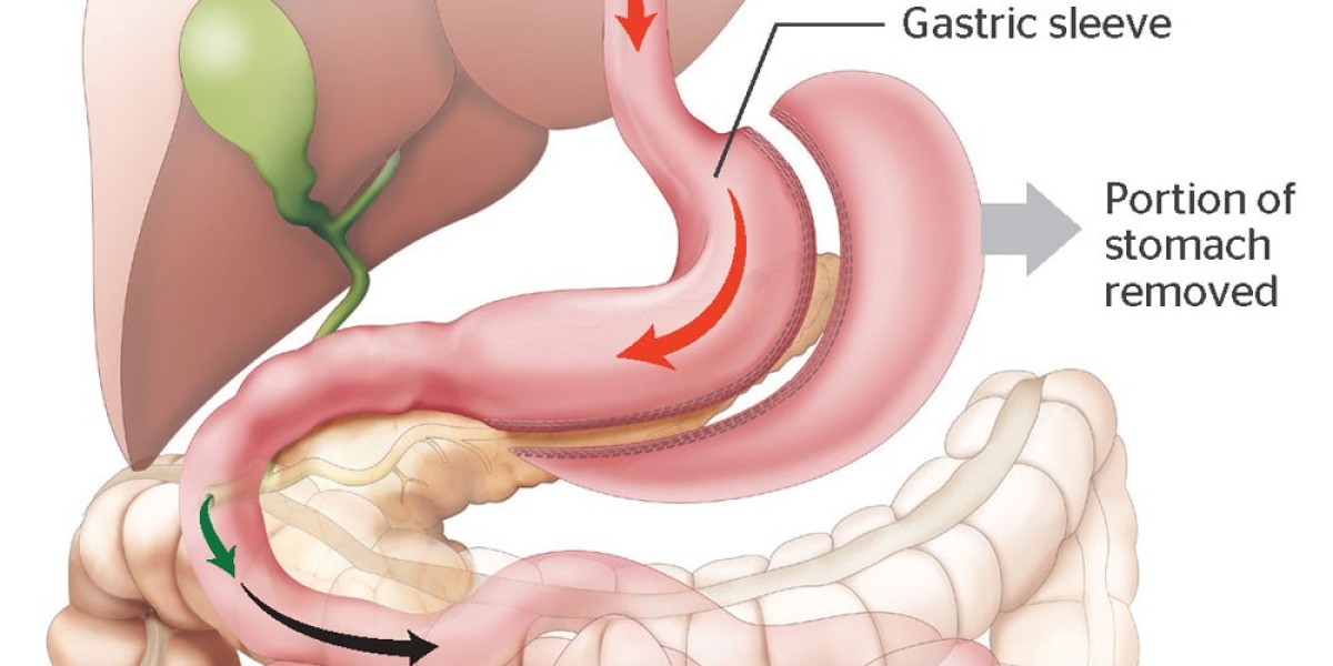 Why Riyadh is Laparoscopic Gastric Sleeve Surgery in Riyadh Right for Your Budget?
