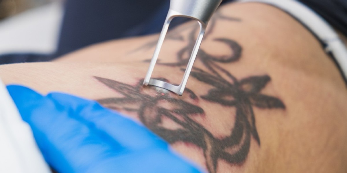 Laser Tattoo Removal for Colorful Tattoos in Dubai