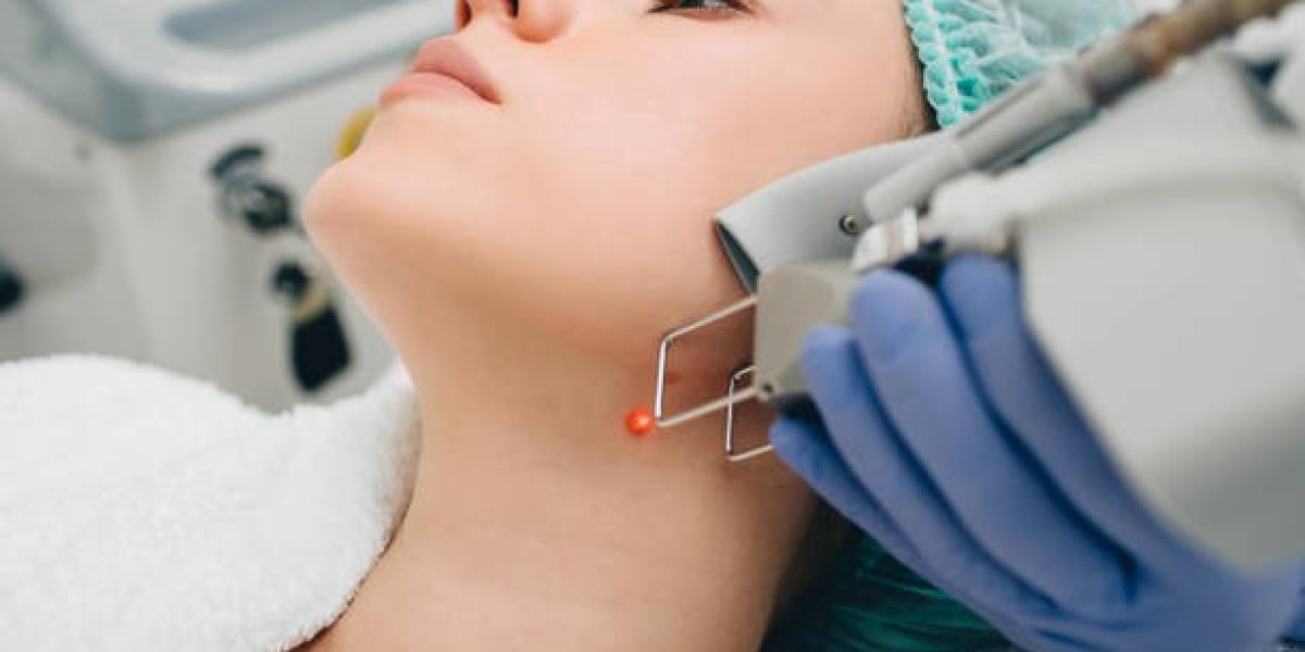 Can Mole Removal Prevent Skin Cancer Risk?