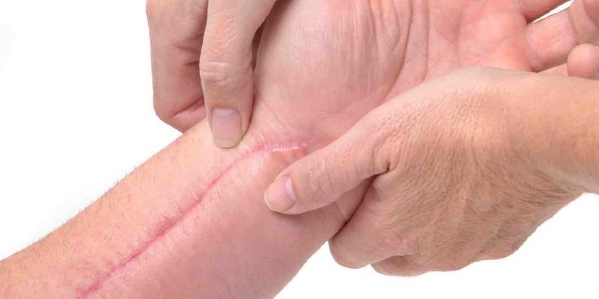 Stitches and Scars: Painful Removal or Easy Healing?