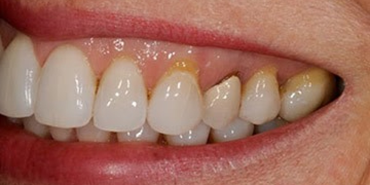 Dental Crowns and Bridges: A Patient’s Journey to Restoration