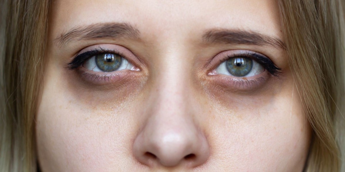 Natural-Looking Solutions for Dark Circles in Riyadh