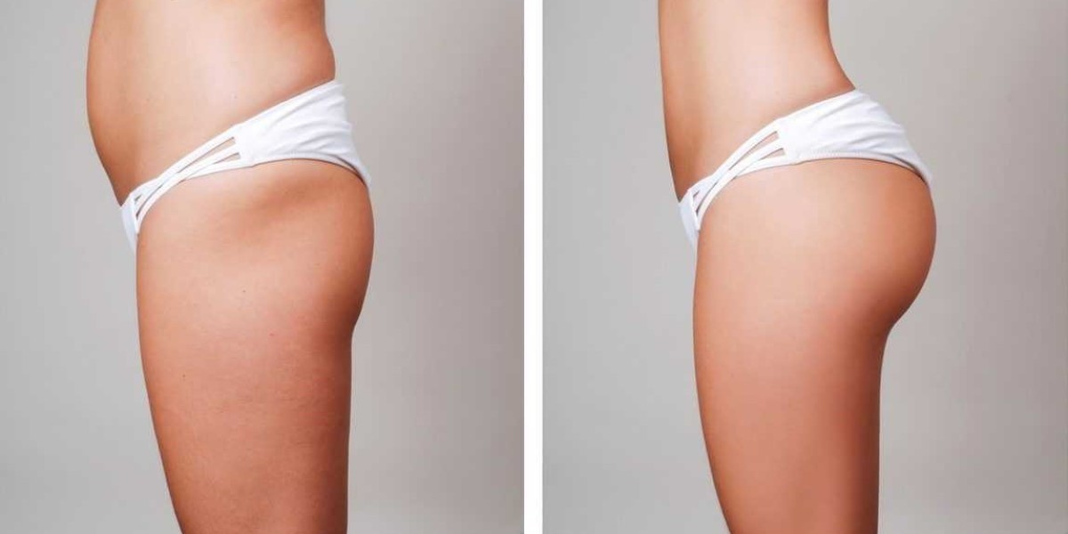 "The Science Behind Butt Fillers: Riyadh Specialists Explain"