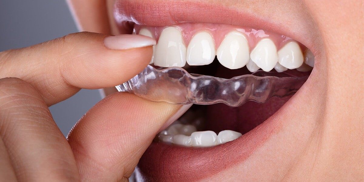 Advanced Orthodontic Treatments: Aligners in Dubai