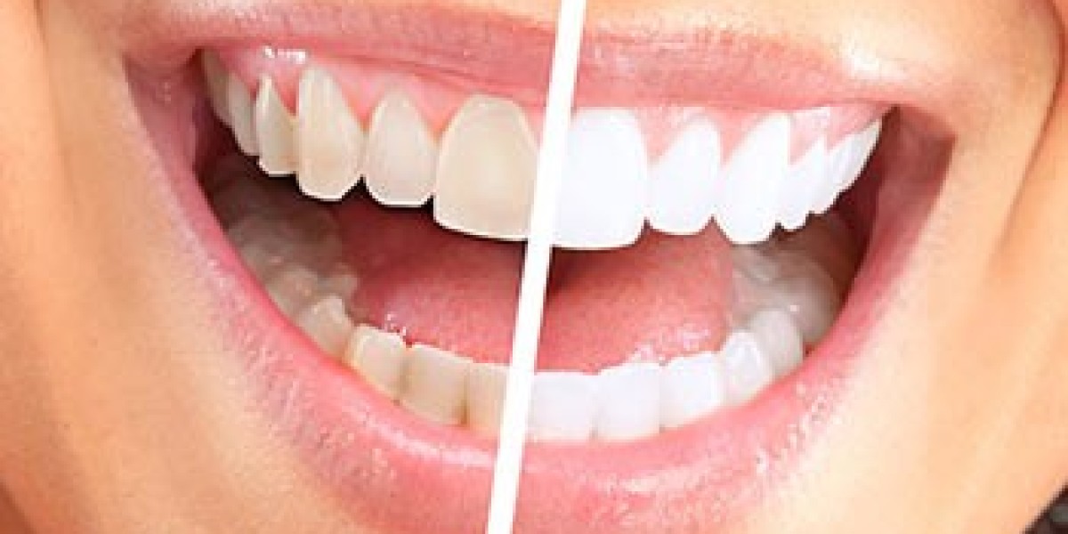 Discover the Best Teeth Whitening Services Available in Dubai