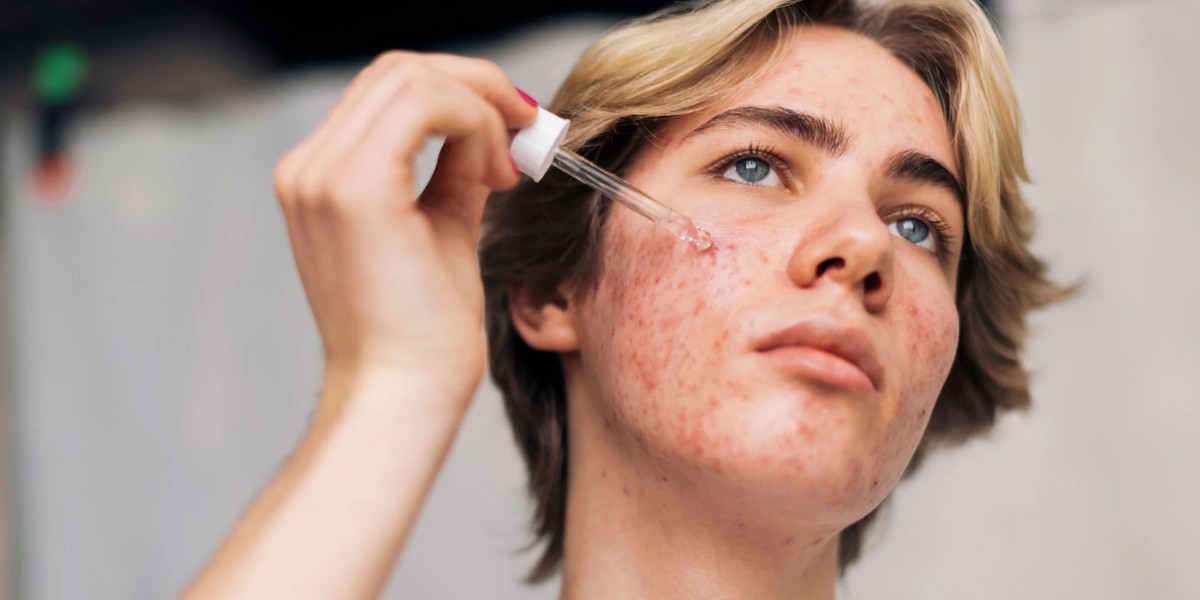 Advanced Acne Treatments for Long-Term Clear Skin